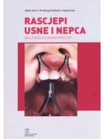 Rascjepi usne i nepca
